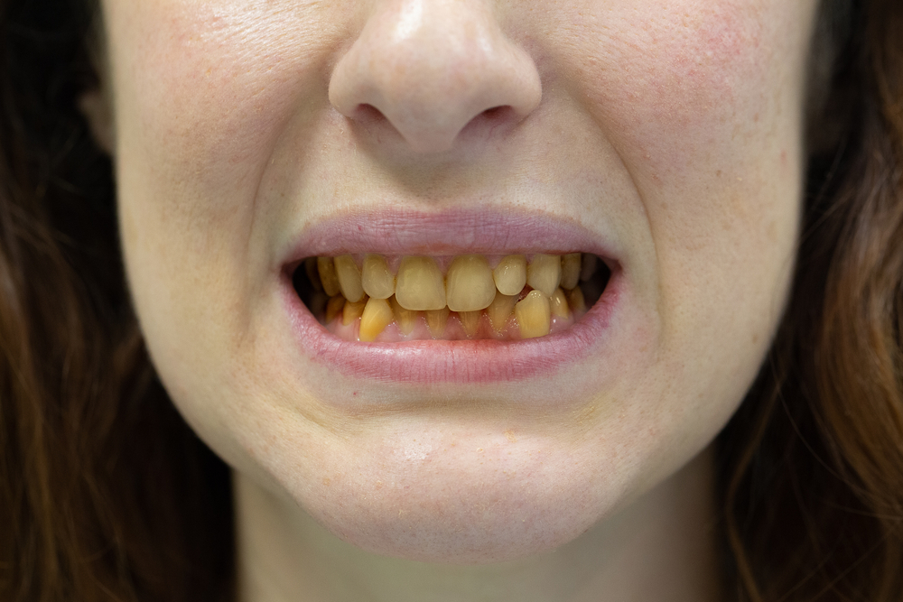 6 Foods to Avoid That Stain Your Teeth